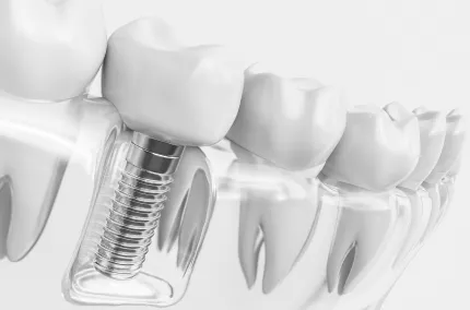 Dental Implants